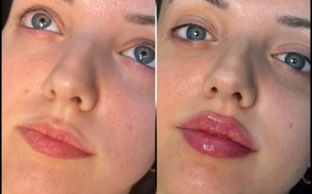 Achieve the Perfect Jawline with the Best Doctors in dubai for Fillers