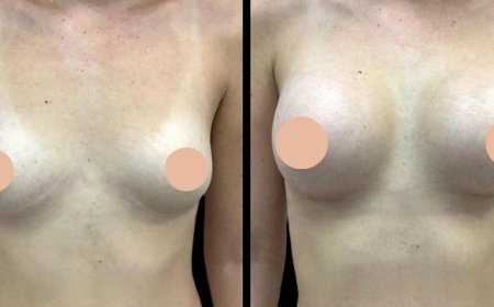 Best Breast Augmentation Surgeon in Dubai: Personalized Consultation for Your Unique Goals