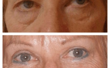 The Science Behind Eye Bag Removal Surgery in Dubai
