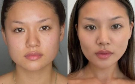 How Long Do Results Last After Buccal Fat Removal Surgery in Dubai?
