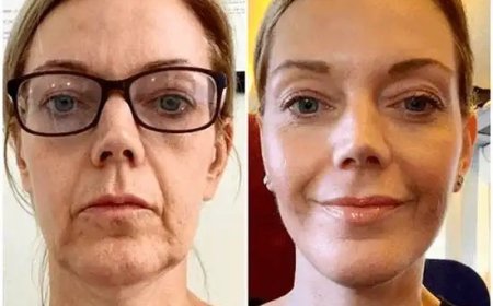 Generate Youthful Appeal via Profhilo from Best Plastic Surgeons in dubai