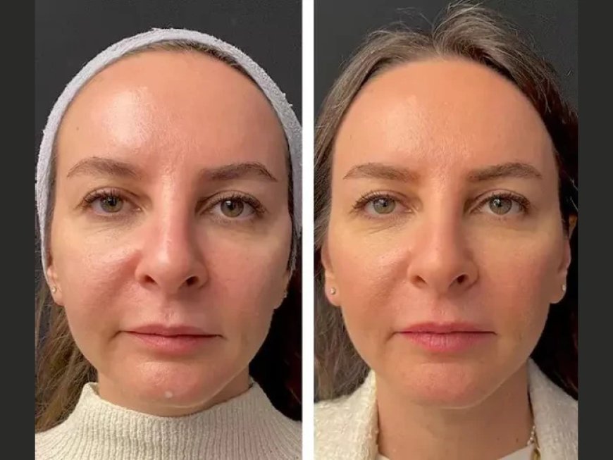 The Science Behind Mesotherapy Treatments in Dubai Explained