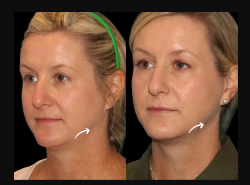Sculptra Fillers Treatments in Dubai Under UAE Medical Guidelines