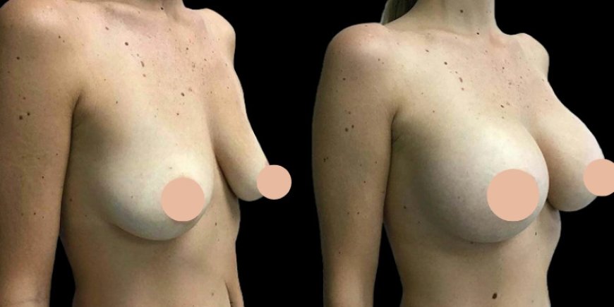 Feel Confident Again with the Best Breast Augmentation Surgeons in Dubai