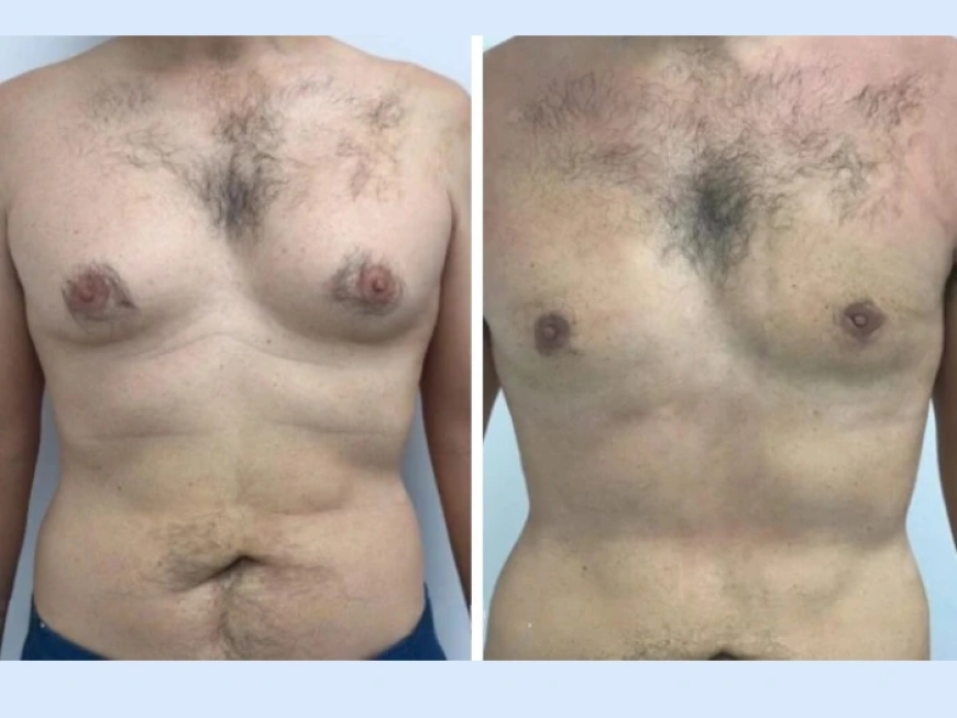How to Identify the Best Gynecomastia Surgeon in dubai for Your Surgery