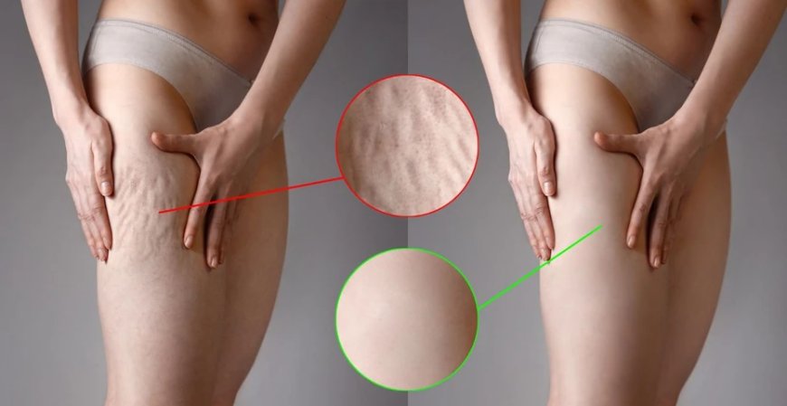 Cellulite Injections NYC: Smooth and Sculpt Your Skin