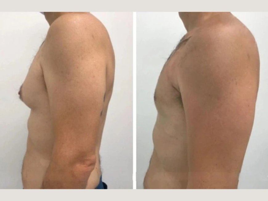 Top Tips for Recovery After Gynecomastia in Dubai