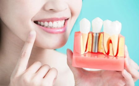 A Complete Guide to Restoring Your Smile with Dental Implants