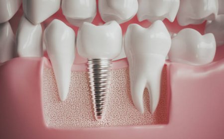 What Makes Dental Implants a Lasting Solution for Missing Teeth?
