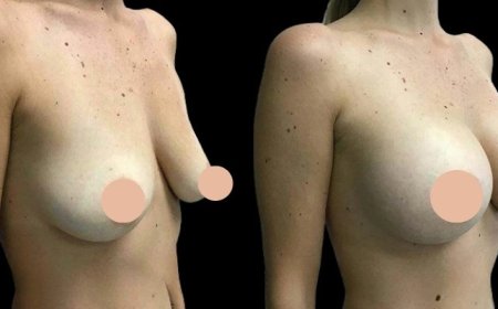 Why Patients Trust Only the Best Doctors in Dubai for Breast Augmentation