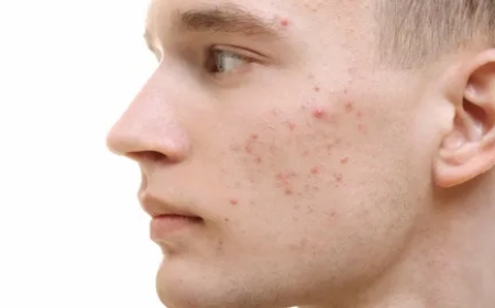 Clearer Skin Awaits: Expert Acne Treatment Facial in Tysons Corner