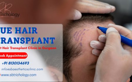 FUE Hair Transplant- Why It Is Popular Nowadays?