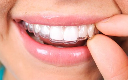 Why Invisalign is the Best Choice for Modern Teeth Straightening