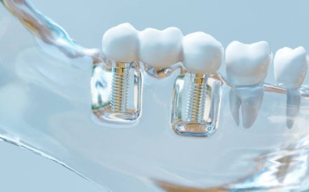 How Dental Implants Boost Oral Health, Confidence & Chewing Power