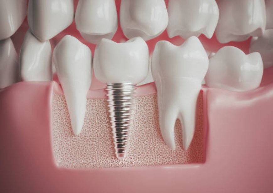 What Makes Dental Implants a Lasting Solution for Missing Teeth?