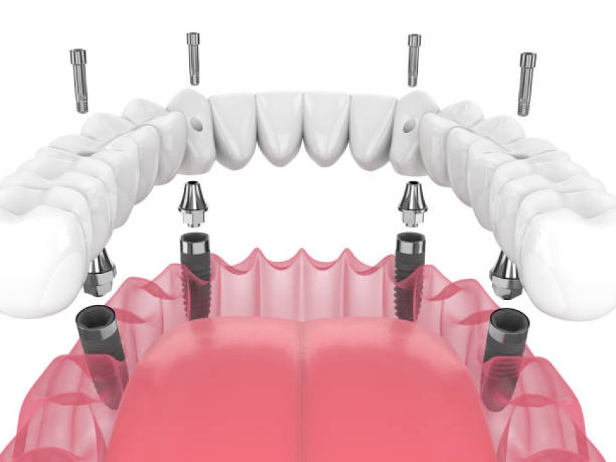What Makes Dental Implants a Lasting Solution for Missing Teeth?