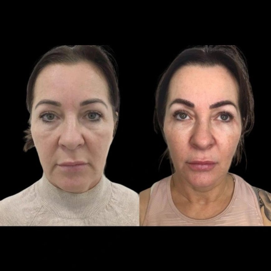 Benefits of Getting Profhilo from the Best Plastic Surgeons in Dubai