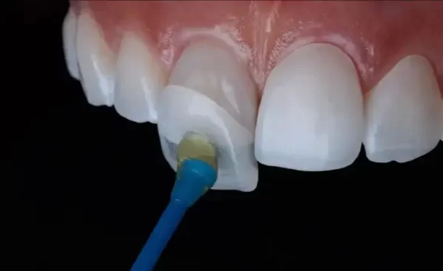 Transform Your Smile with Confidence: A Complete Guide to Veneers in Encino