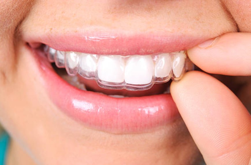 Why Invisalign is the Best Choice for Modern Teeth Straightening