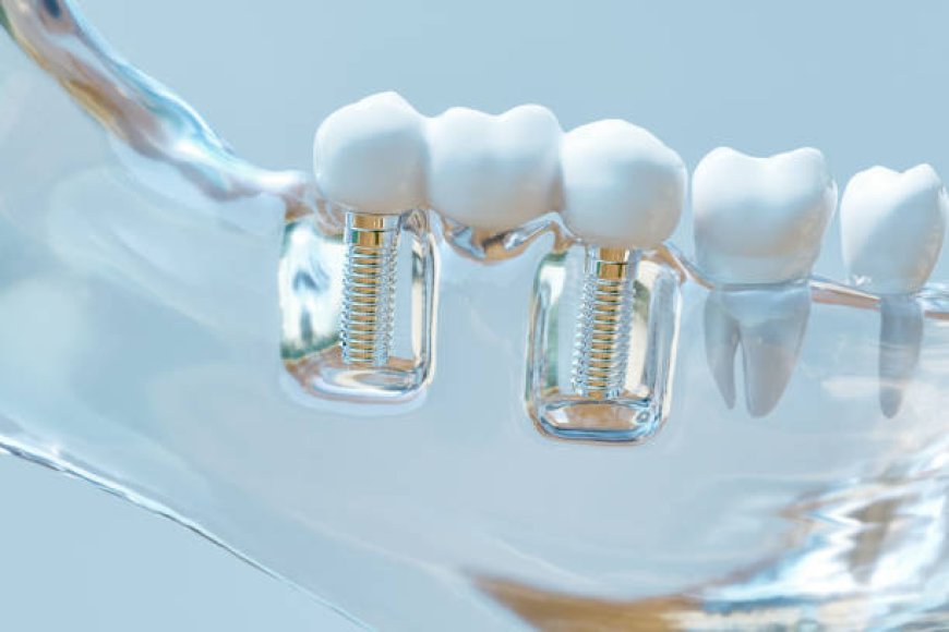 How Dental Implants Boost Oral Health, Confidence & Chewing Power